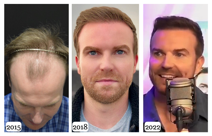 Permanent and Natural Hair Transplantation with The Martinick Technique™